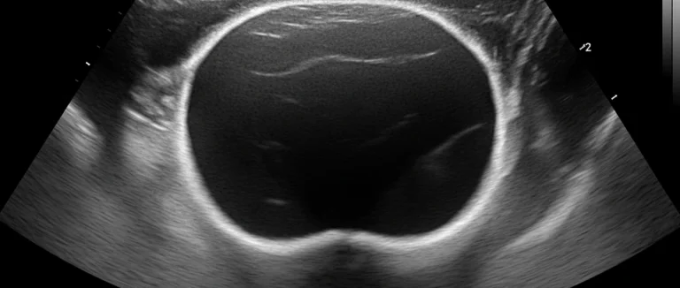 УЗИ мочевого пузыря