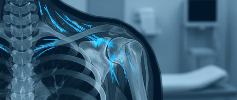 МРТ плеча при тендините