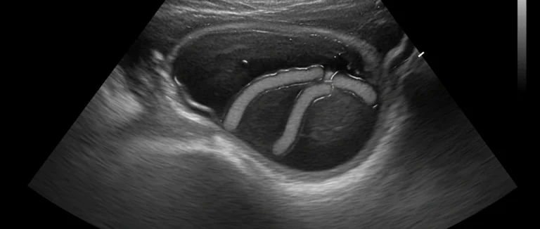 УЗИ сухожилия руки при отёке