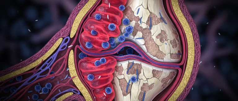 Воспалённый сустав под микроскопом