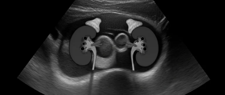 Ультразвуковое исследование почек