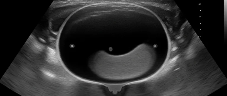 УЗИ мочевого пузыря