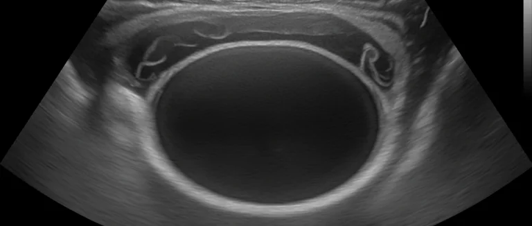 УЗИ мочевого пузыря