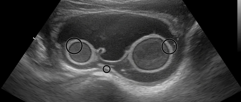 Ультразвуковое исследование сосудов половых органов