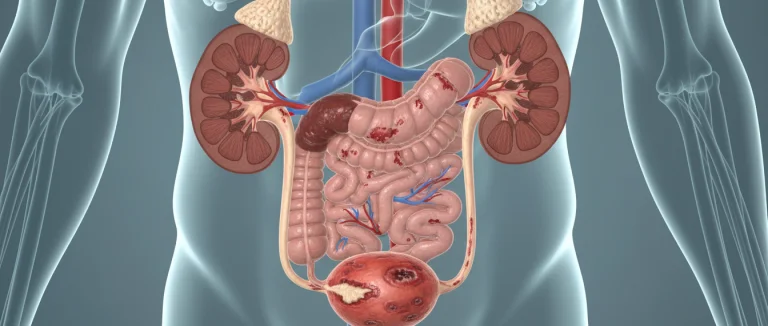 Инфекция мочевого тракта