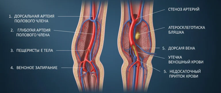 Схема сосудистых причин эректильной дисфункции
