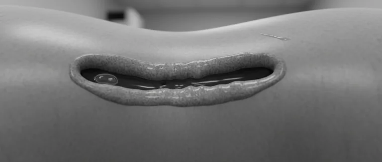 УЗИ уретры, показывающее сужение