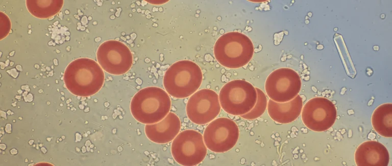 Микроскопический вид эритроцитов в моче
