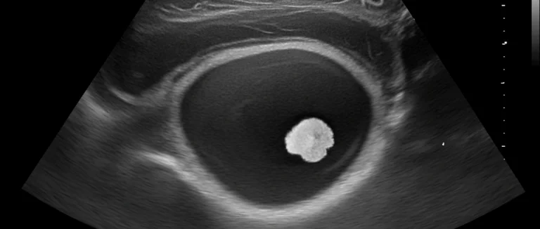 УЗИ органов малого таза, показывающее камень в мочевом пузыре