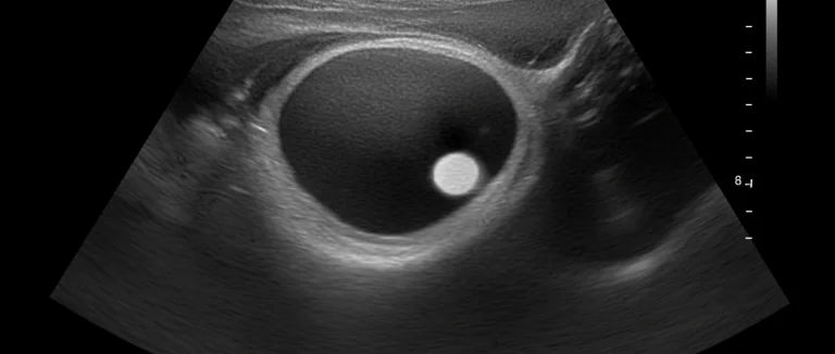 Камни в почках на УЗИ