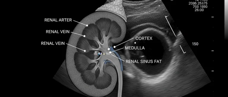 УЗИ почек при ИМП