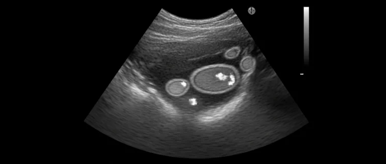 УЗИ сухожилий пальцев