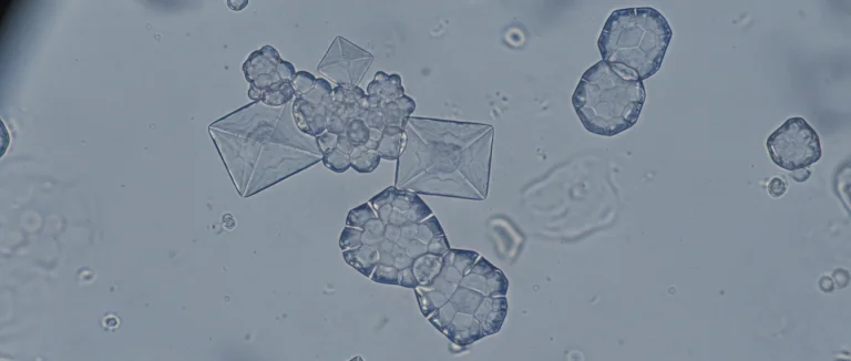 Микроскопический снимок мочи с кристаллами