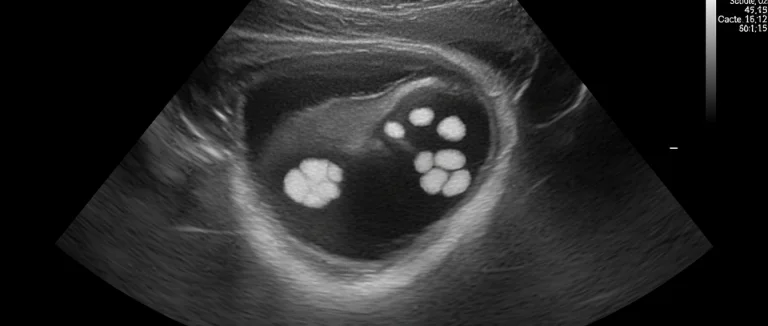 Камни почки в ультразвуковом изображении