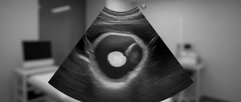 УЗИ почек с камнем