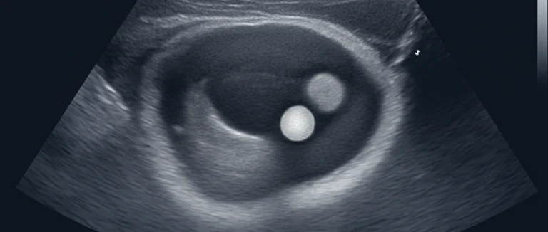 Камни в почках, вид на УЗИ