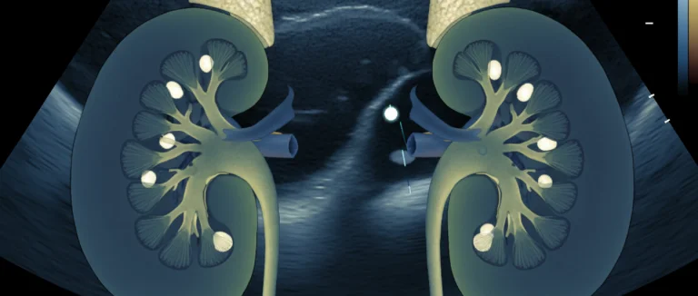 Изображение камней в почках при УЗИ