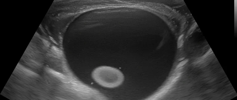 УЗИ мочевого пузыря