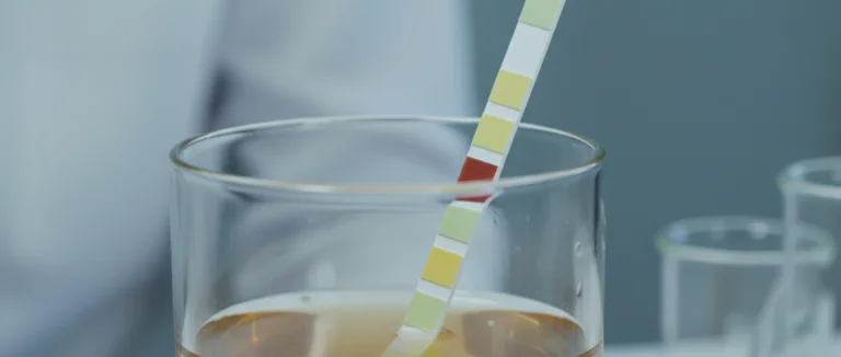 Анализ мочи, показывающий микрогематурию