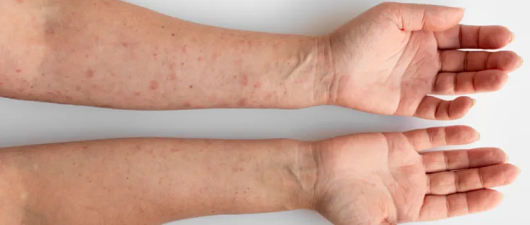 What Is Actinic Keratosis?