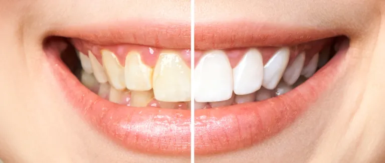 Diş Beyazlatma