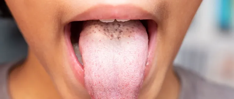 Dil Kanseri Tedavisi