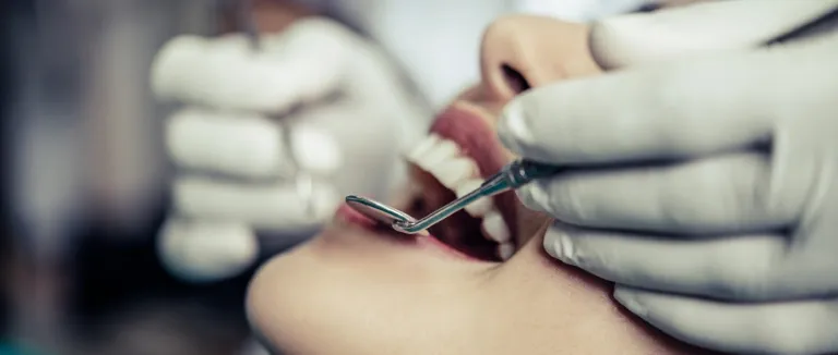 Diş Taşı Temizliği Nedir?