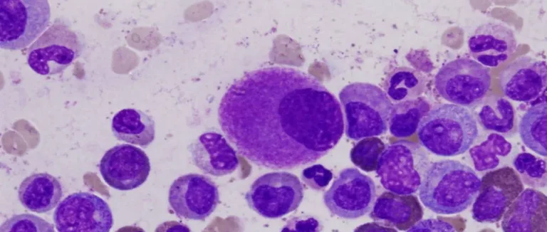 Comment Dure la Radiothérapie Adjuvante pour le Cancer du Sein?