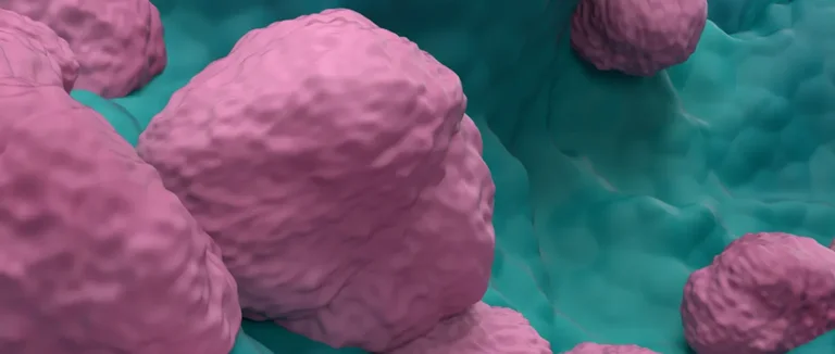 Qu'est-ce que le Carcinome Surrénalien et Quels Sont Ses Symptômes?