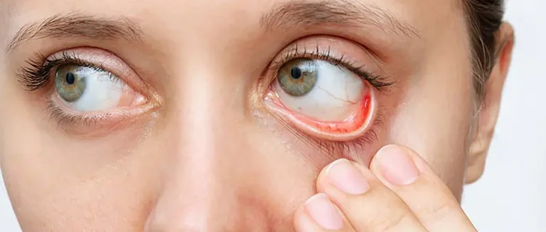 L'Inflammation Peut-Elle Causer l'Anémie ? Comprendre le Lien Entre les Maladies Chroniques et la Carence en Fer