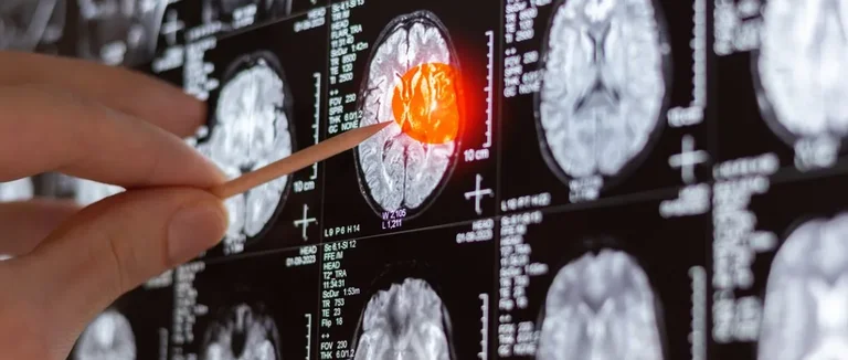 Comment Obtenir des Injections Dorsales pour le Soulagement de la Sténose Spinale