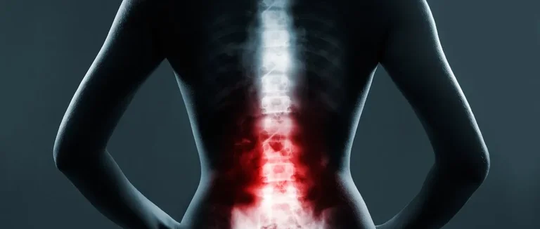 Comment Obtenir des Injections Épidurales pour la Sténose Spinale