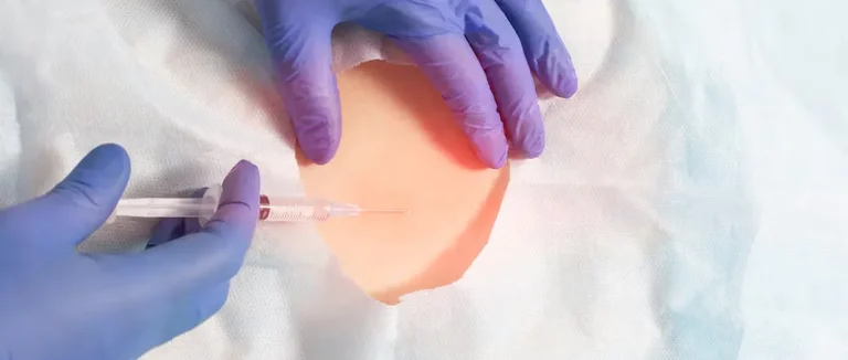 À quelle fréquence peut-on recevoir des injections épidurales de stéroïdes?