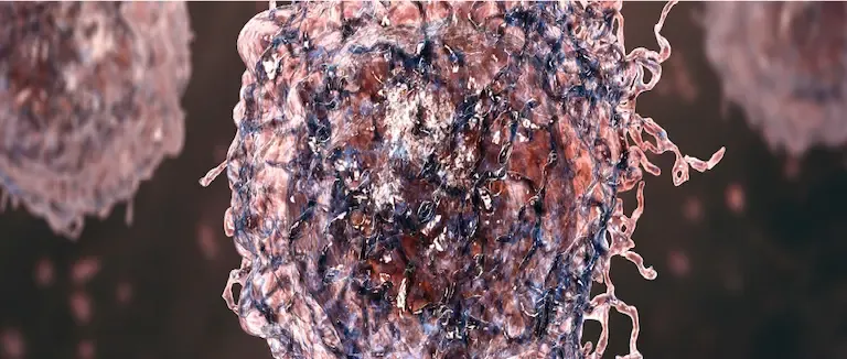 Langerhans Hücreli Histiositoz Nedir?