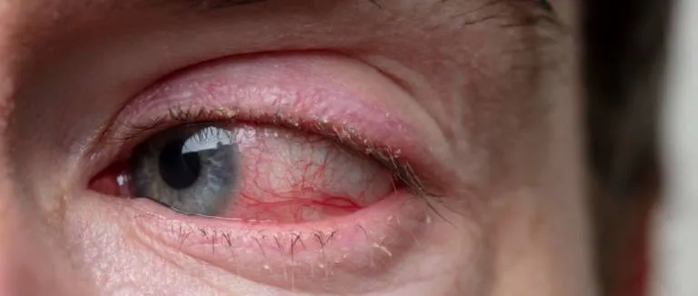 Kara Mantar Hastalığı Nedir?