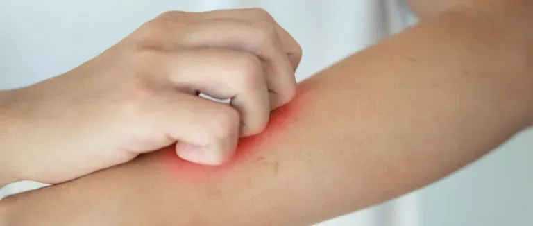 Batı Nil Virüsü Belirtileri