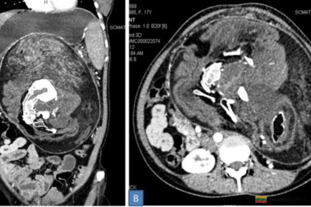 Компьютерная томография