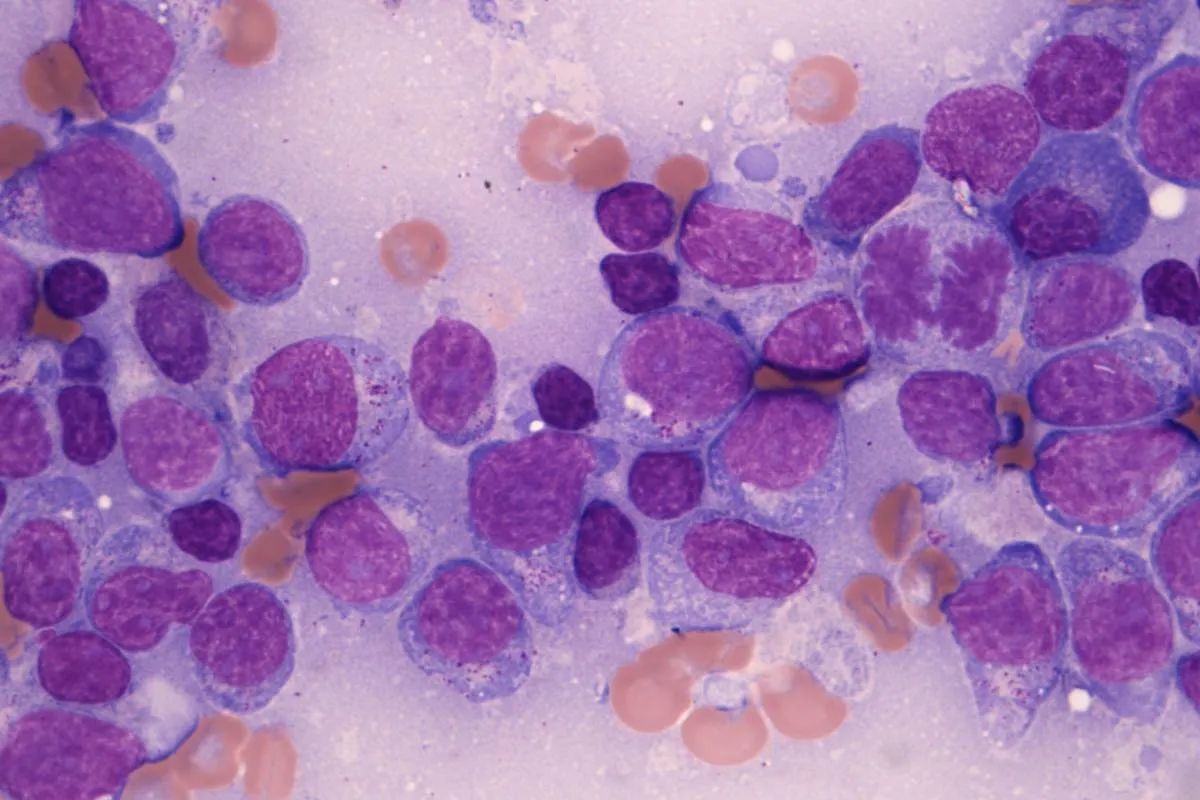 B-клеточная лимфома