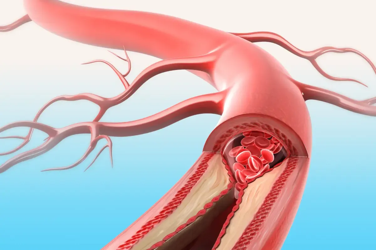 Как предотвратить артериальный тромбоз: основные шаги