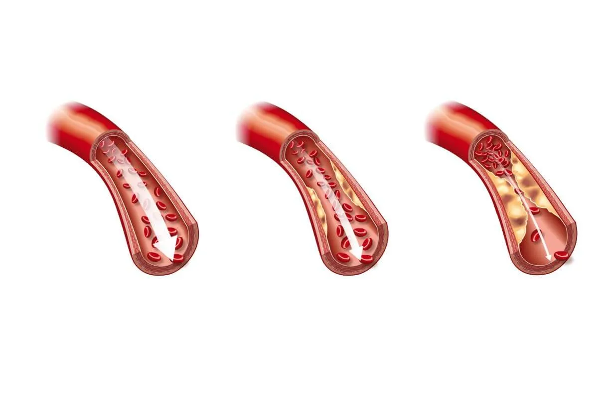 Артериальный тромбоз