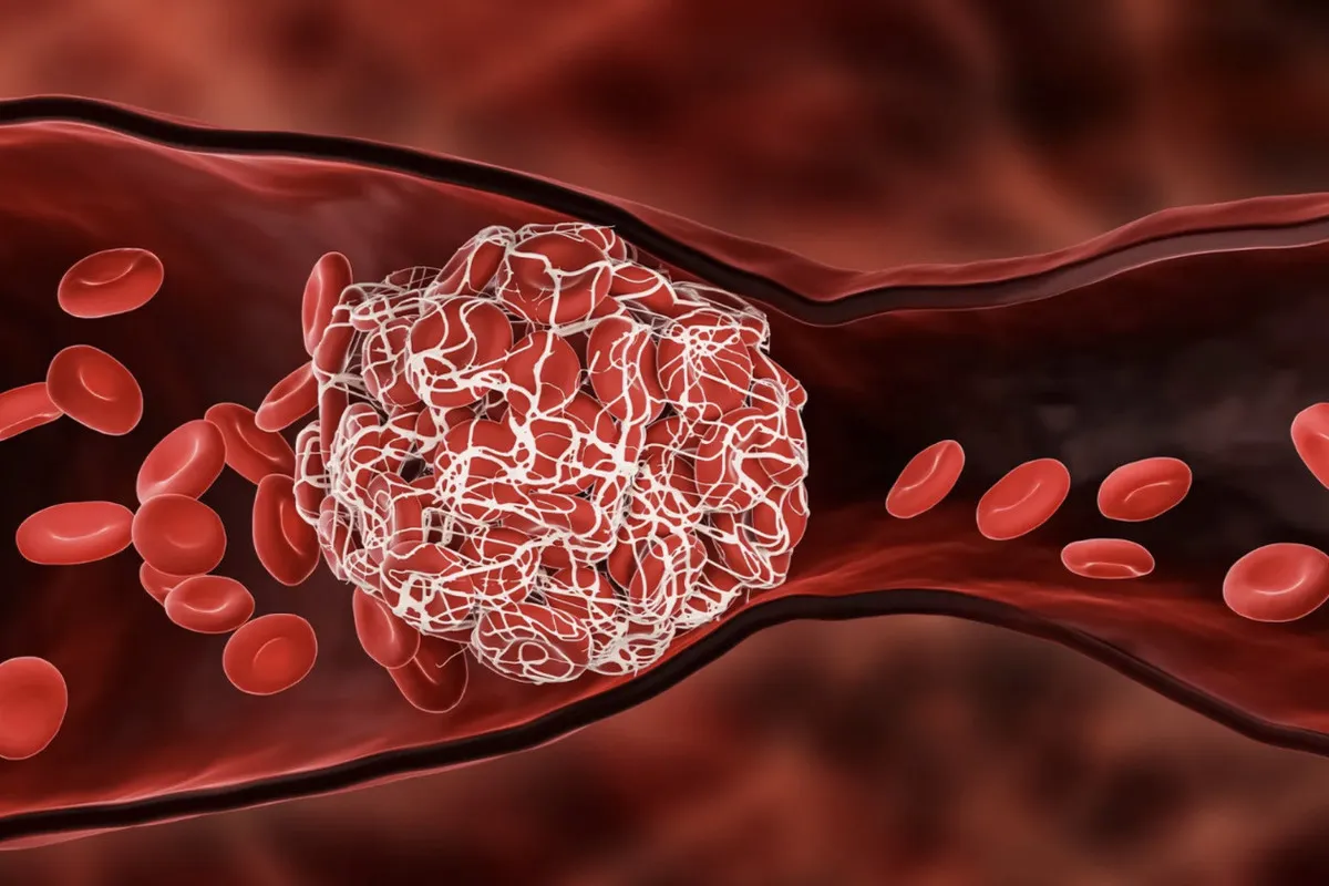 Артериальный тромбоз