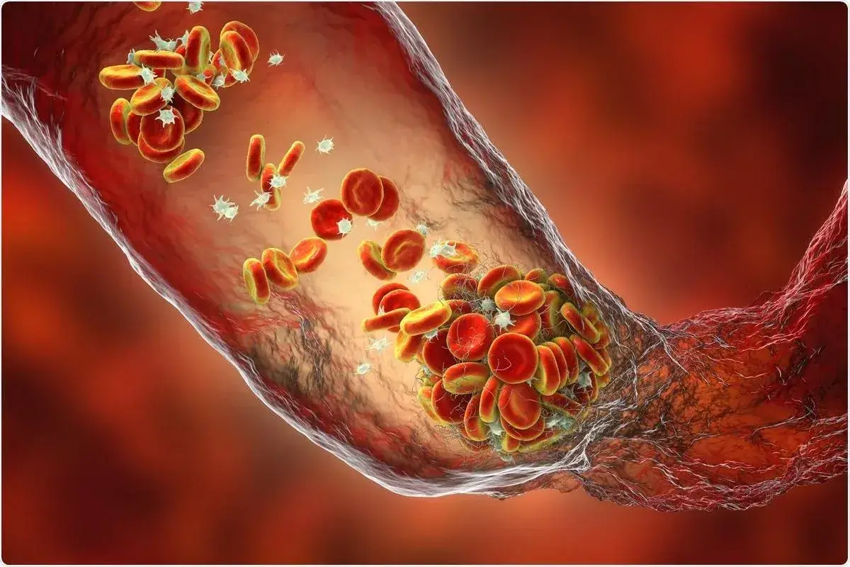 Что Такое Тромб? Медицинское Определение и Значение