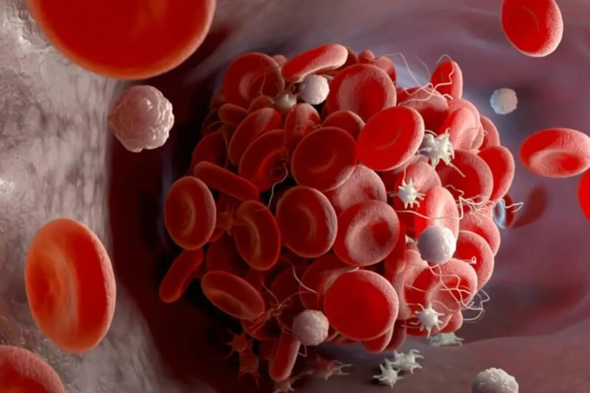 Как распознать острый тромбоз: ключевые признаки