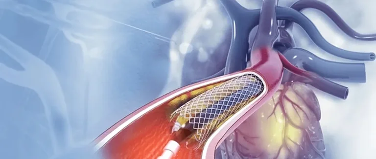 Эндометриоз