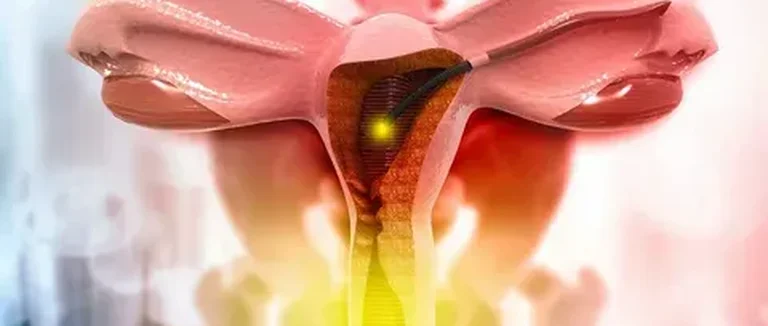 лапароскопическая миомэктомия