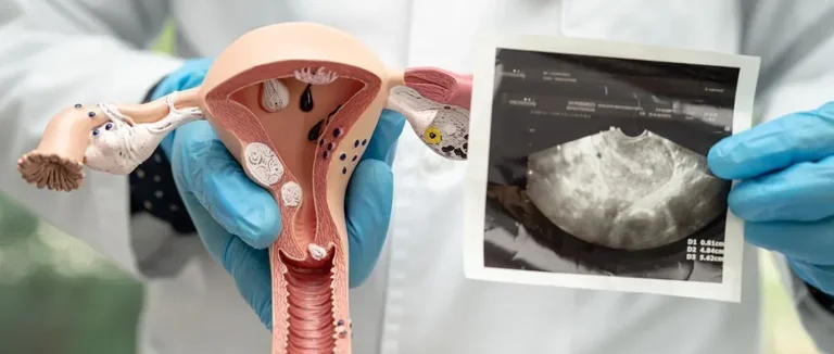 Лапароскопическая миомэктомия