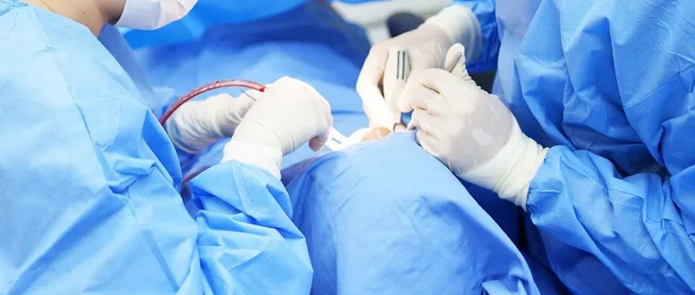 Миомэктомия,