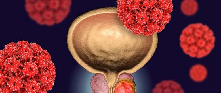шкала Глисона