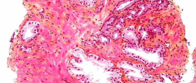 рак простаты