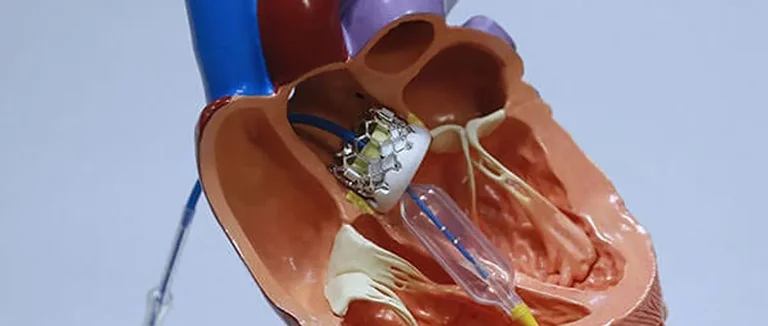 митральный клапан